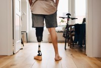 Health Insurers Limit Coverage of Prosthetic Limbs, Questioning Their Medical Necessity