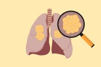 Racial Disparities in Lung Cancer Start With Research