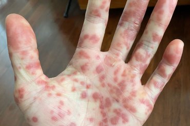 A California Man’s ‘Painful and Terrifying’ Road to a Monkeypox Diagnosis